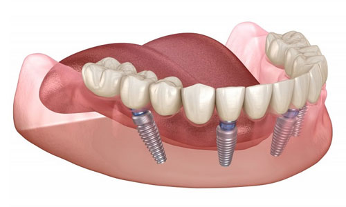 Имплантация зубов Аll on 6