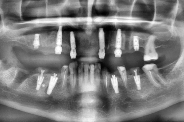 Рентген всей челюсти после установки имплантов