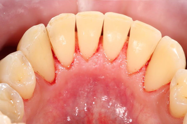 После чистки Airflow зубов нижней челюсти
