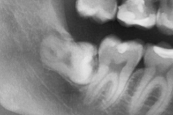 Рентген зуба который нужно удалить