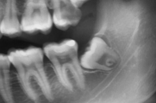 Рентген зуба мудрости который нужно удалить