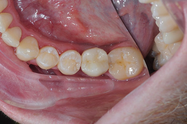 Имплантация 6-го зуба нижней челюсти