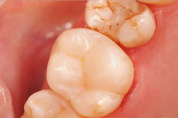 После лечения кариеса на 6-м зубе