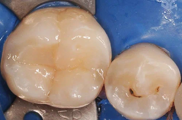 После лечения кариеса на зубе