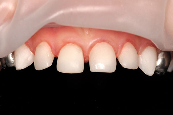 После лечения пульпита нескольких зубов под наркозом у ребенка