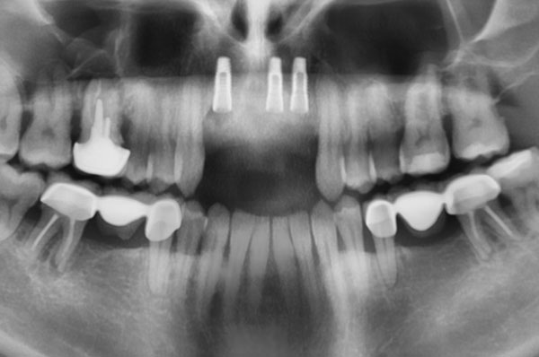 Рентген зубов после удаления и установки имплантов