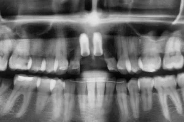 Рентген зубов после удаления и установки имплантов
