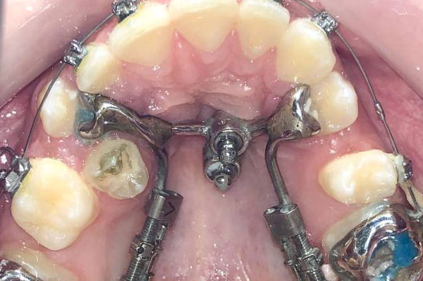 В процессе работы по выправлению положения зубов верхней челюсти