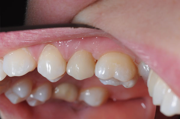 Результат после протезирования зубов