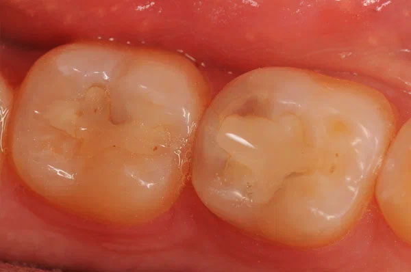 До раставрации зуба - старая пломба