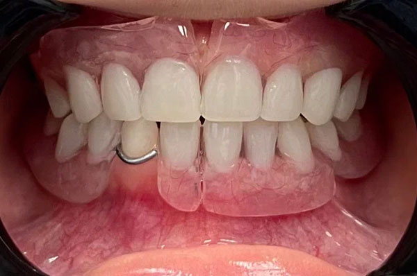 Результат после установки съемного протеза зубов подростку