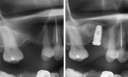 Рентген до и после наращивания кости