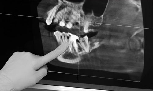 Рентгеновский снимок зуба, подлежащего лечению канала