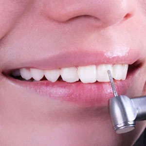 Обработка зубов перед установкой виниров