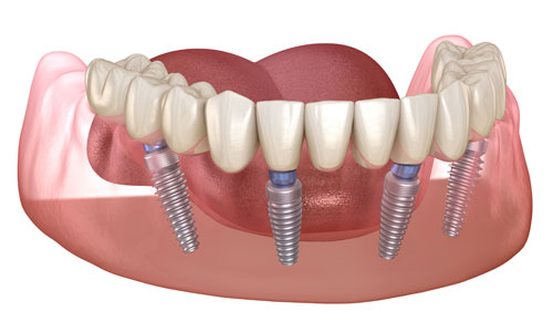 Имплантация зубов Аll on 4