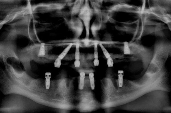 Рентген всей челюсти после установки имплантов