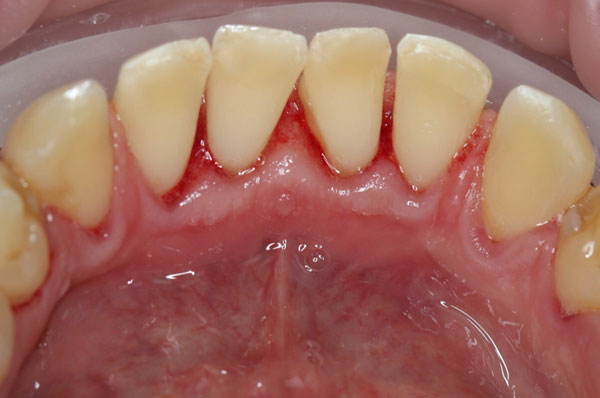 После комплексной чистки зубов нижней челюсти
