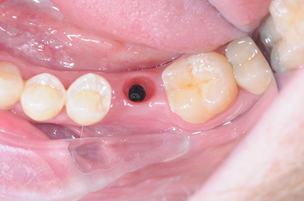 Подготовка к имплантации 6-го зуба нижней челюсти