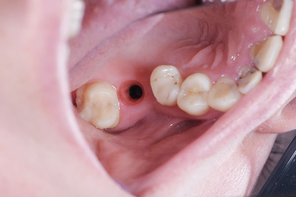 Подготовка к имплантации 7-го зуба верхней челюсти