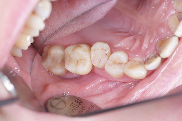 Имплантация 7-го зуба верхней челюсти