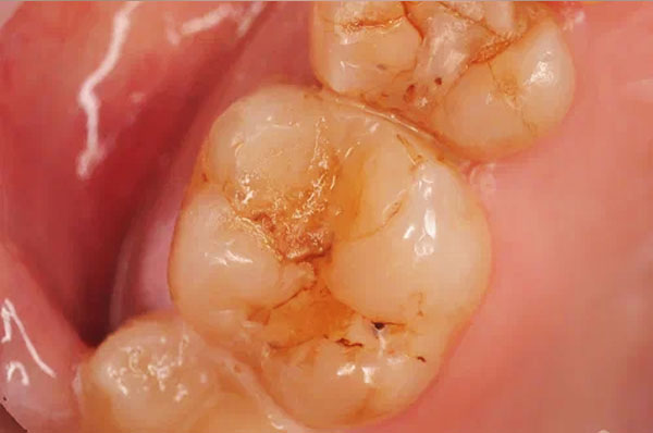 До лечения кариеса на 6-м зубе