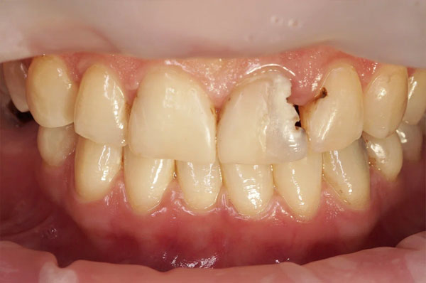 До лечения переднего зуба