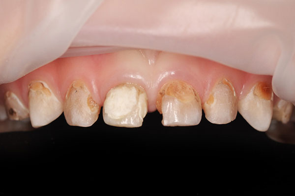 До лечения пульпита нескольких зубов под наркозом у ребенка