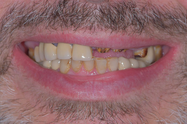 До удаления зубов и установки иплантов под наркозом мужчине