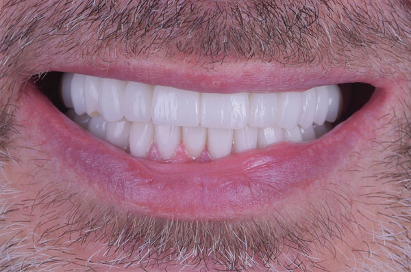 После удаления зубов и установки иплантов под наркозом мужчине