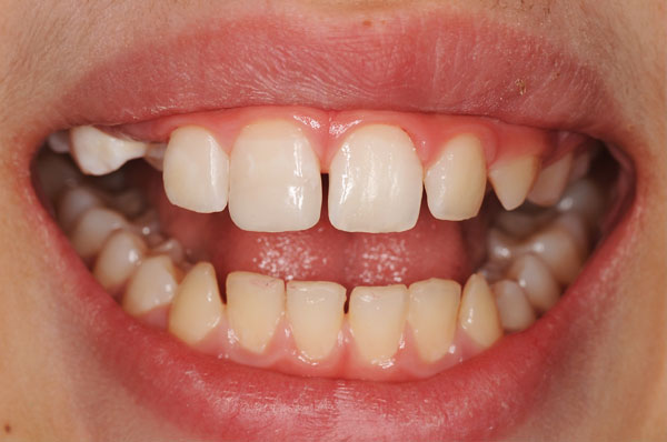 Результат после пломбирования передних зубов