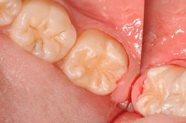 После раставрации зуба