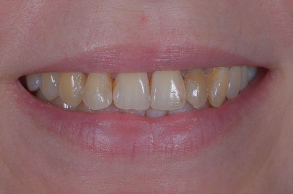 До лечения и имплантации зубов под седацией