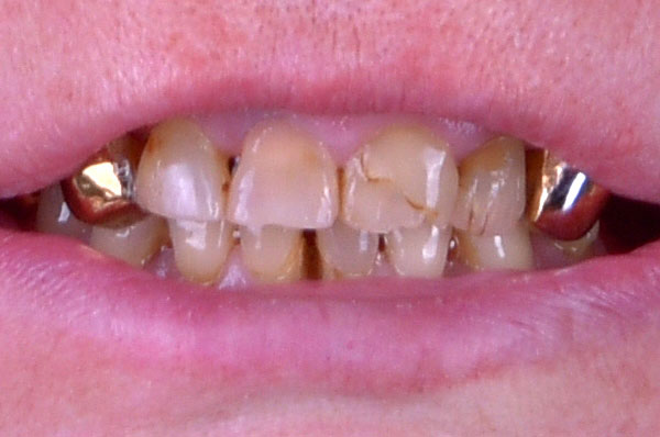 До установки виниров на передние зубы с высокой стираемостью