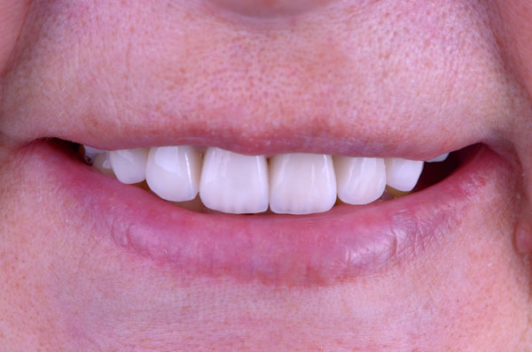 После установки виниров на передние зубы с высокой стираемостью