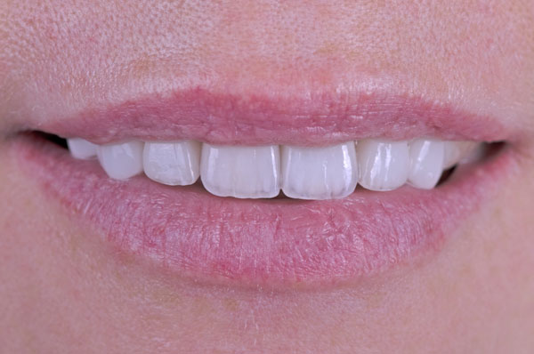 После установки виниров на передние зубы обеих челюстей