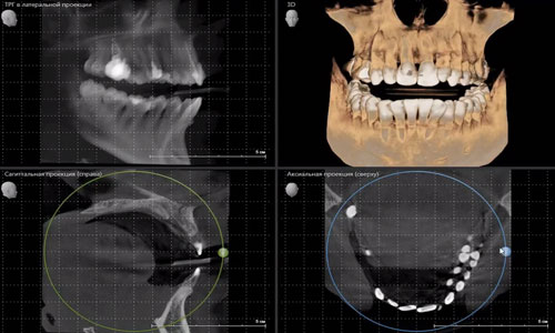 Компьютерная томография челюсти