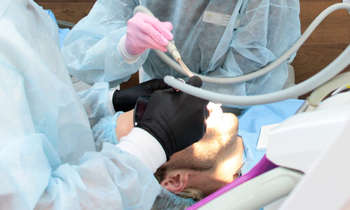 Процесс удаления зубного камня