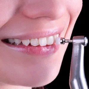 Чистка зубов перед установкой виниров
